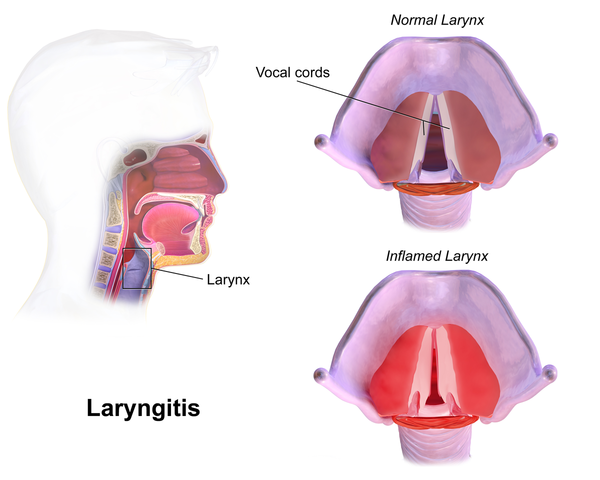 Laryngitis chronische Pharyngitis
