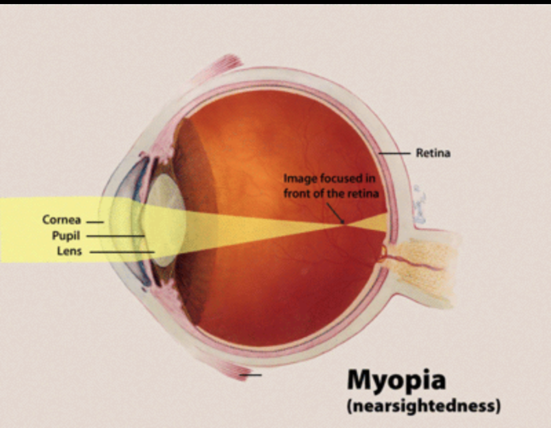 miopia 2 este tratată vedere 0 0 per ochi