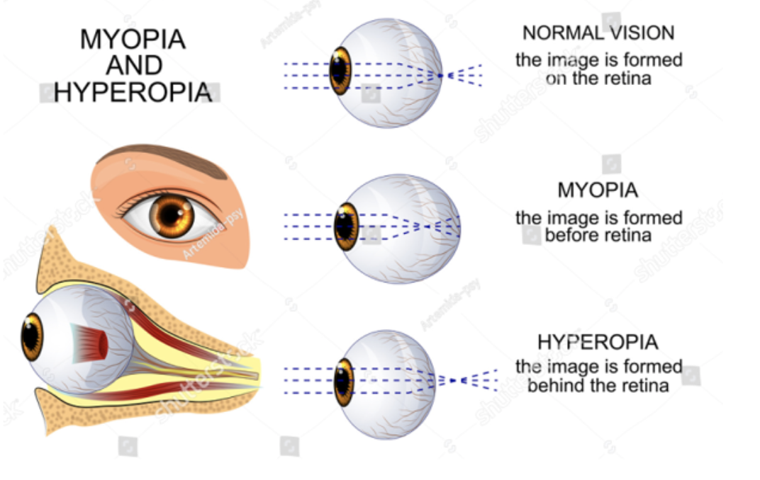 Miopia si hipermetropia, Diferențe de hipermetropie și miopie