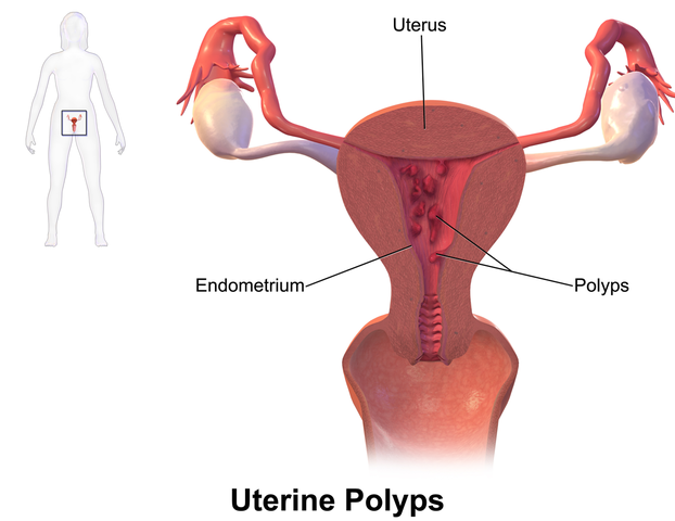 polyp endometrial provoacă pierderea în greutate