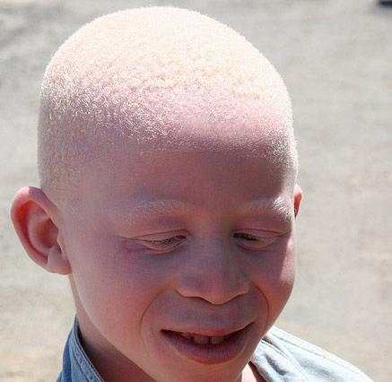 viziunea albinismului)
